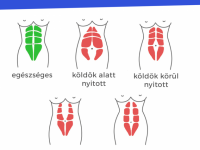 Minden, amit tudnod kell a szétnyílt hasizomról